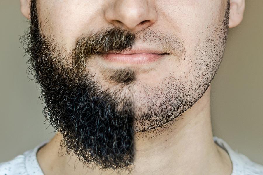 Mi barba dejó de crecer, ¿qué hago?